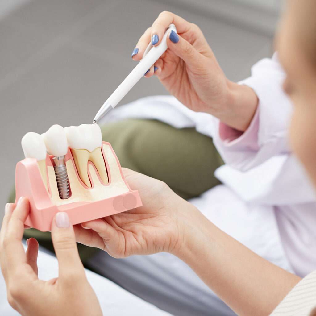 Spiegazione dell'impianto di denti