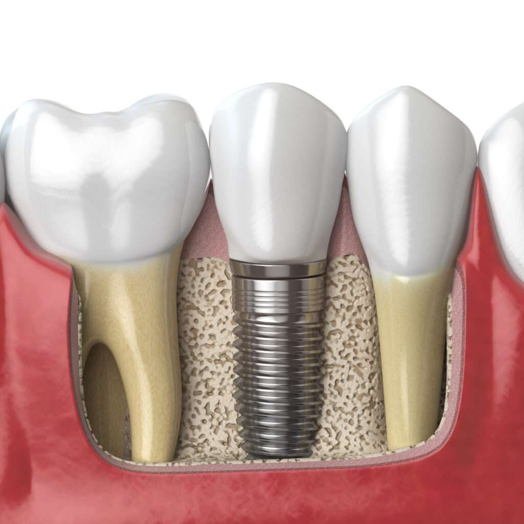 Anatomia dei denti sani e degli impianti dentali nella dentatura umana.