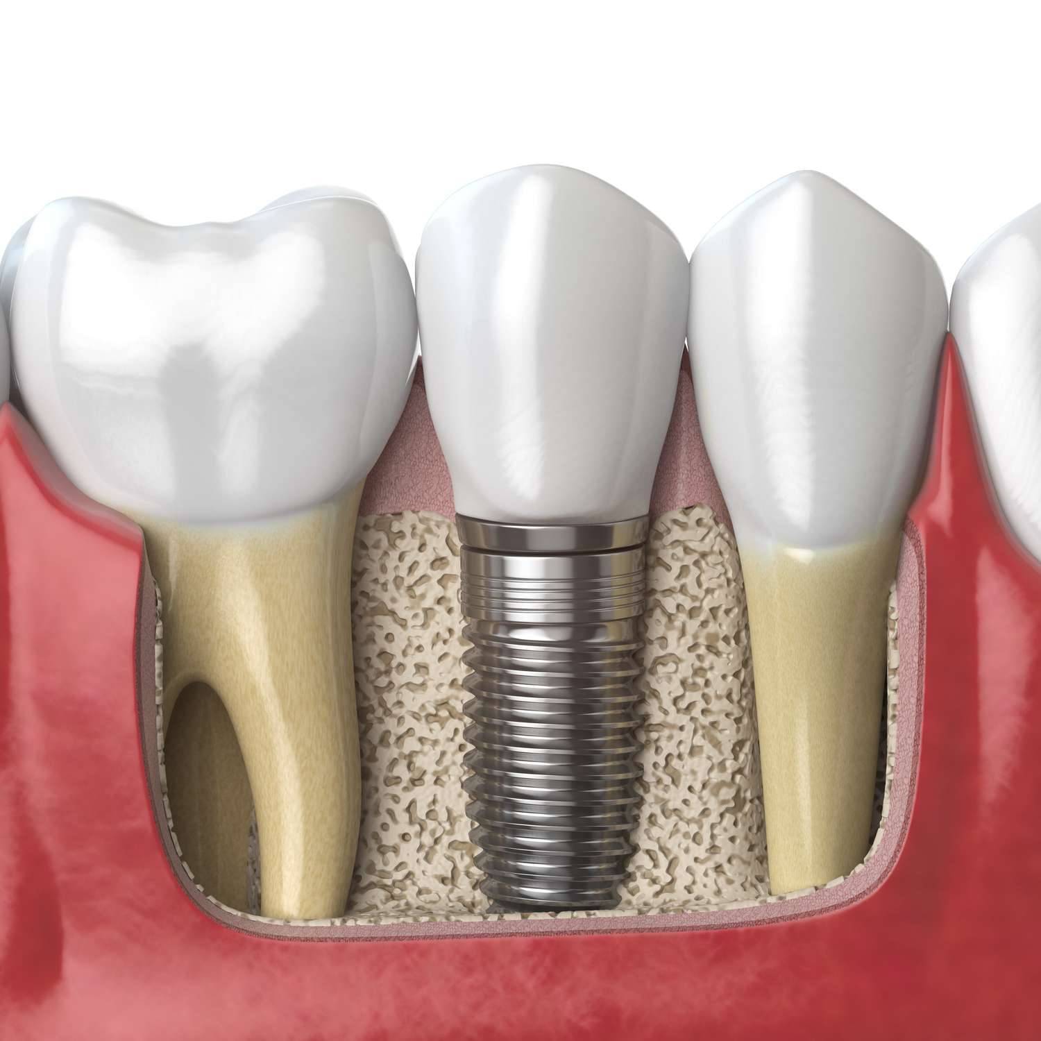 Anatomy of healthy teeth and tooth dental implant in human dentura.
