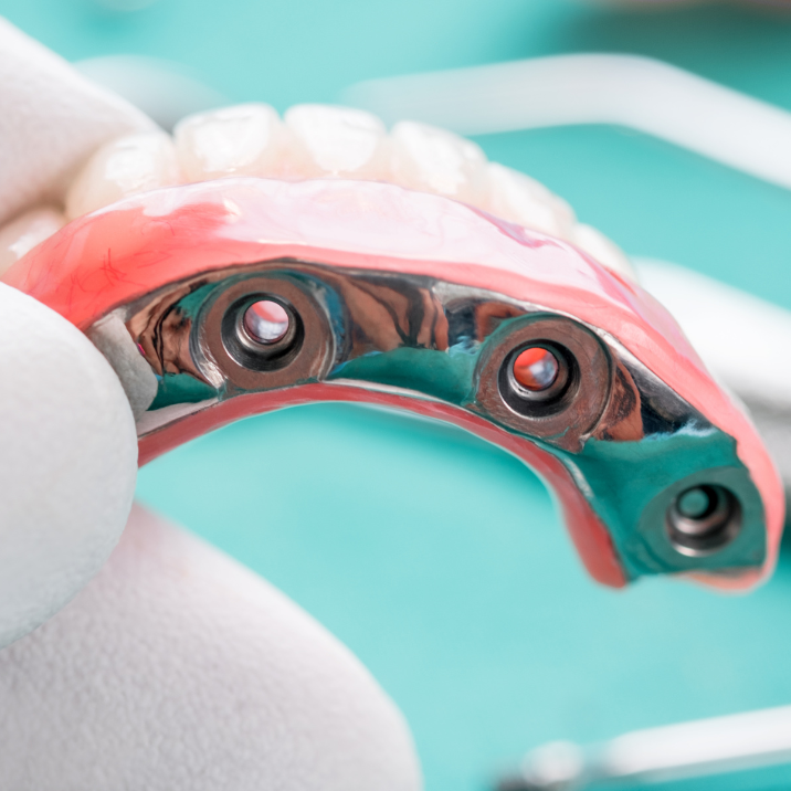 Complete denture supported by dental implants pic