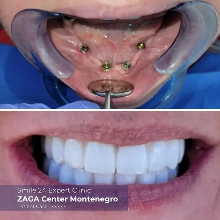 before after dentures