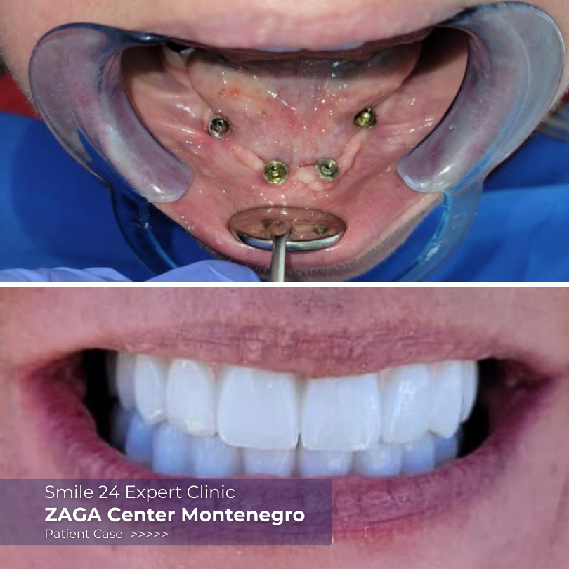 ZAGA Center Montenegro before and after implants fixed dentures