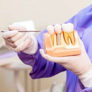 Explication sur les implants dentaires