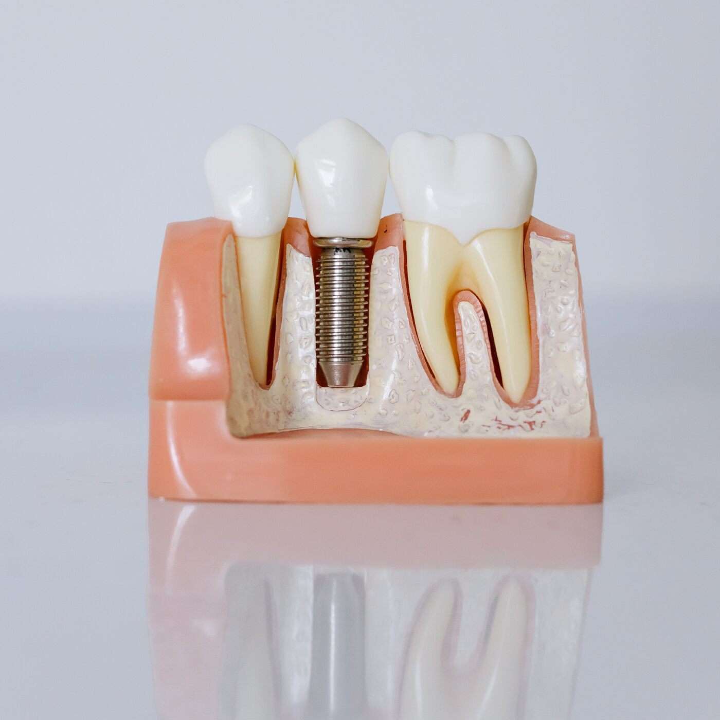 Implant Schematic