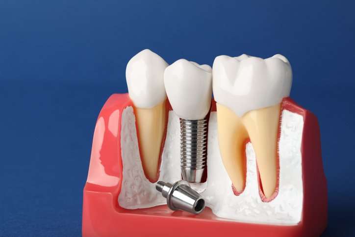 Educational model implant