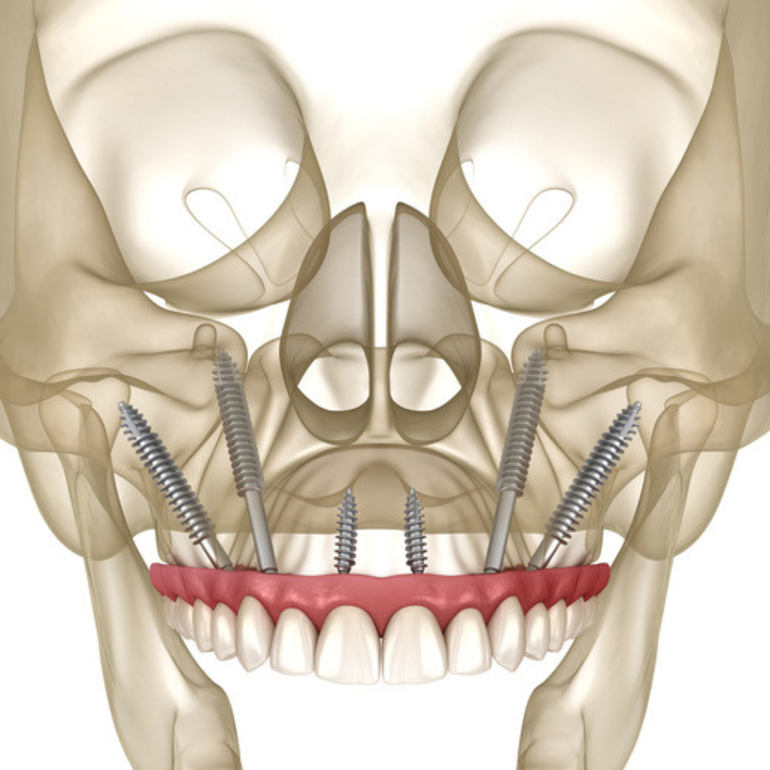 zygomatic-implant-anatomy