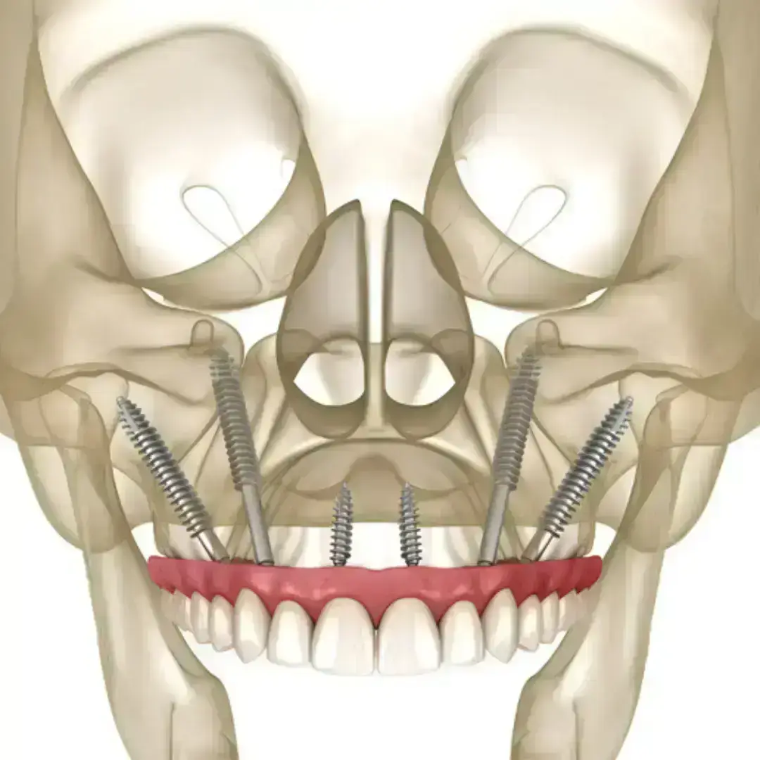zygomatic-implant-anatomy