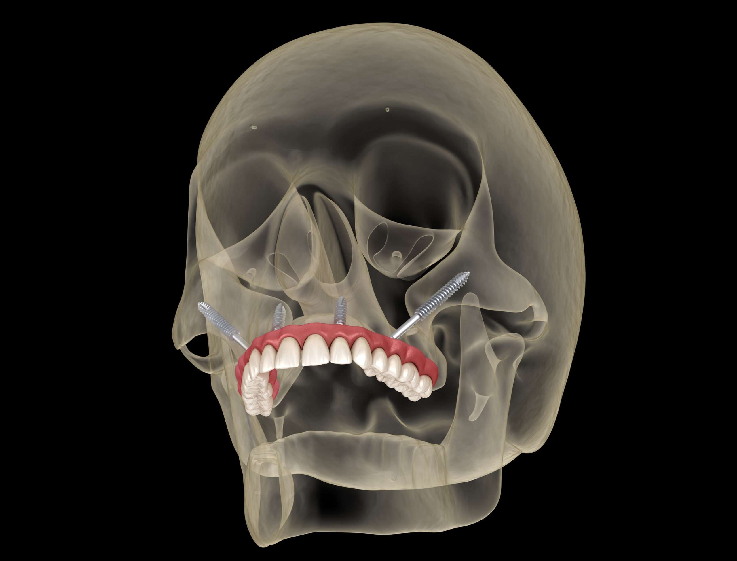 Maxillary prosthesis implants