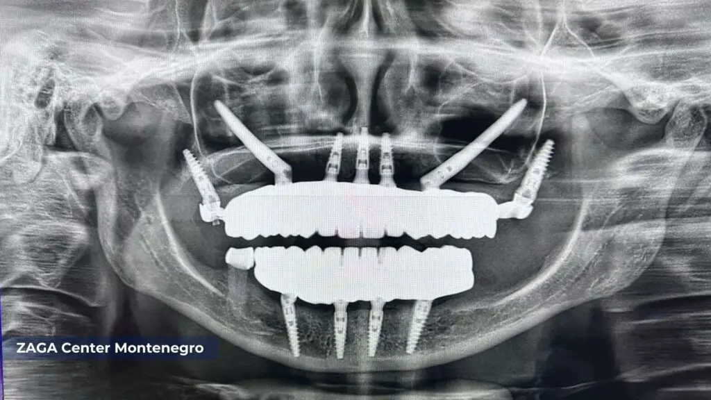 ZAGA Center Montenegro - Zygomatic Implants Real Patient CTL