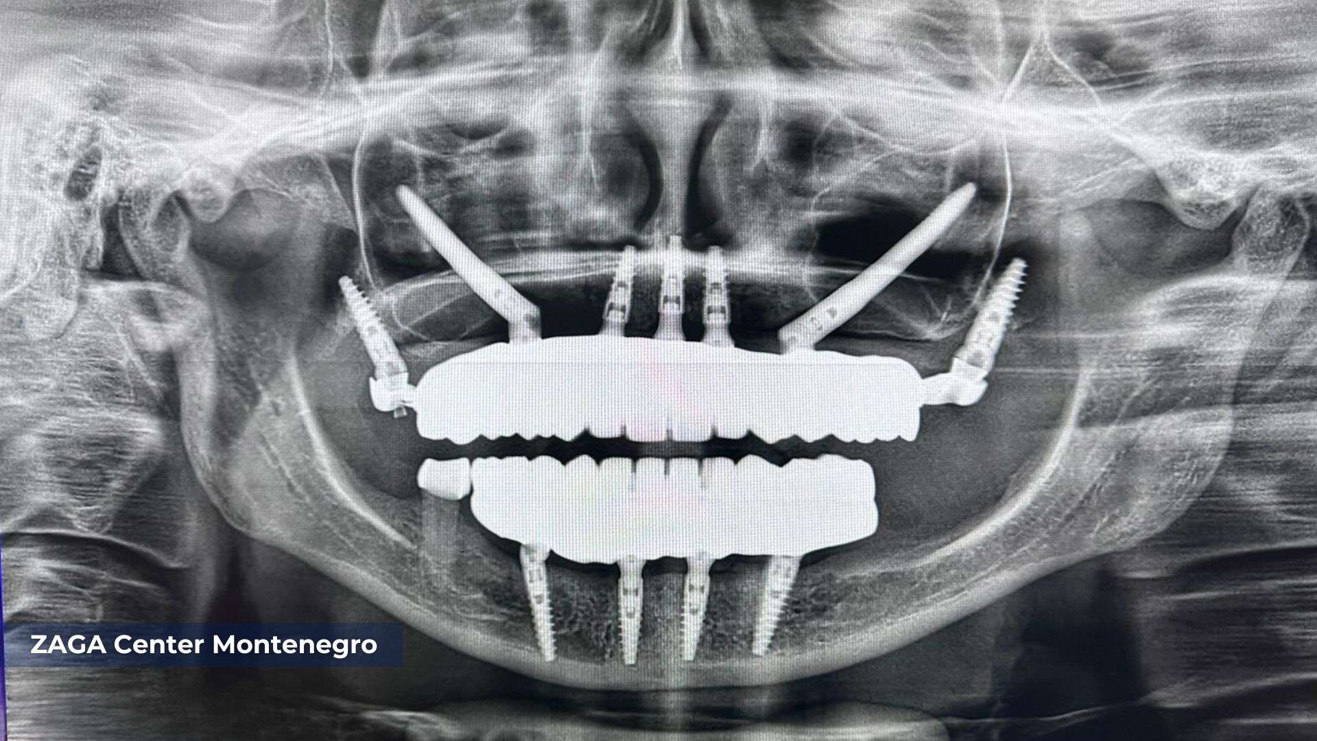 ZAGA Center Montenegro - Zygomatic Implants Real Patient CTL