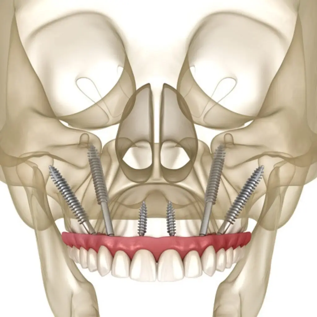 zygomatic implants in position