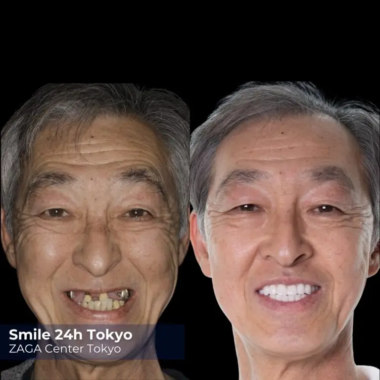 Before After 2
