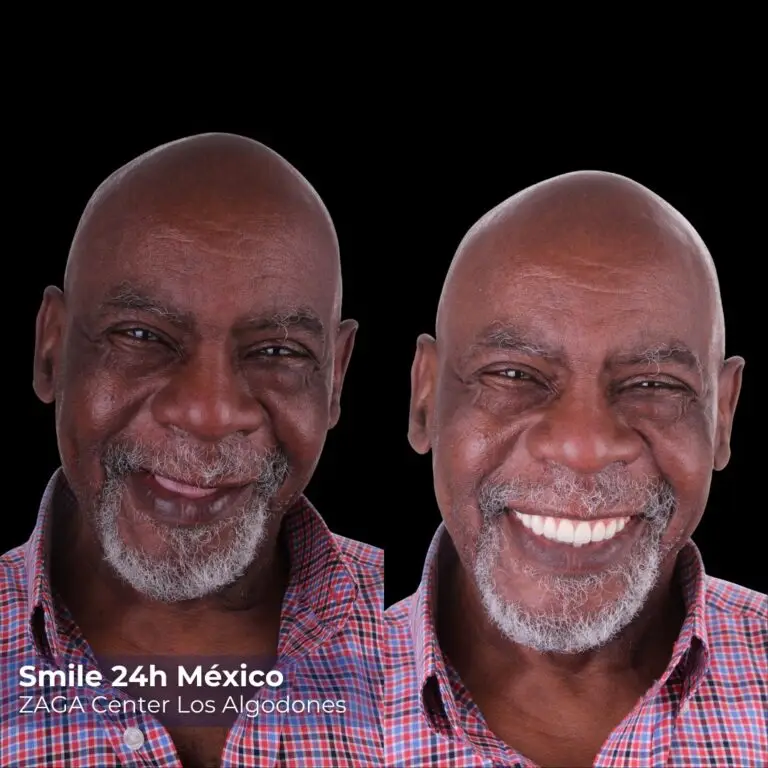 Before After 6