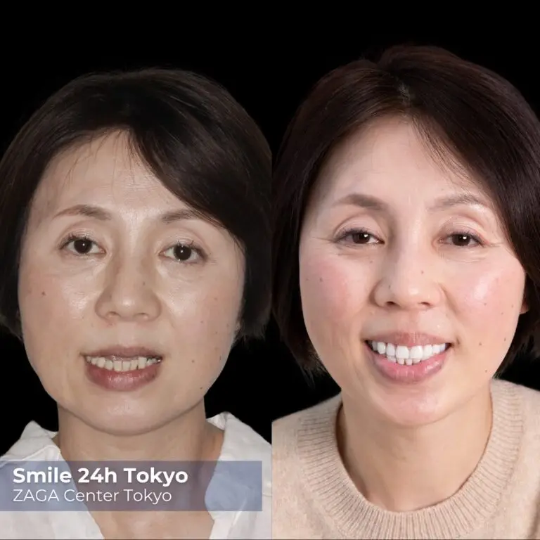 Before After Implants 3