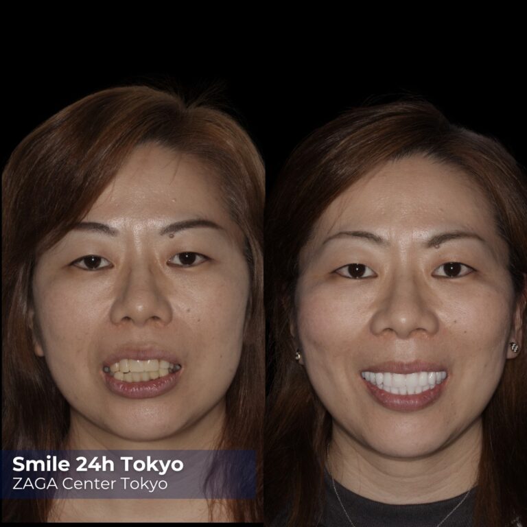 Before After Implants 4
