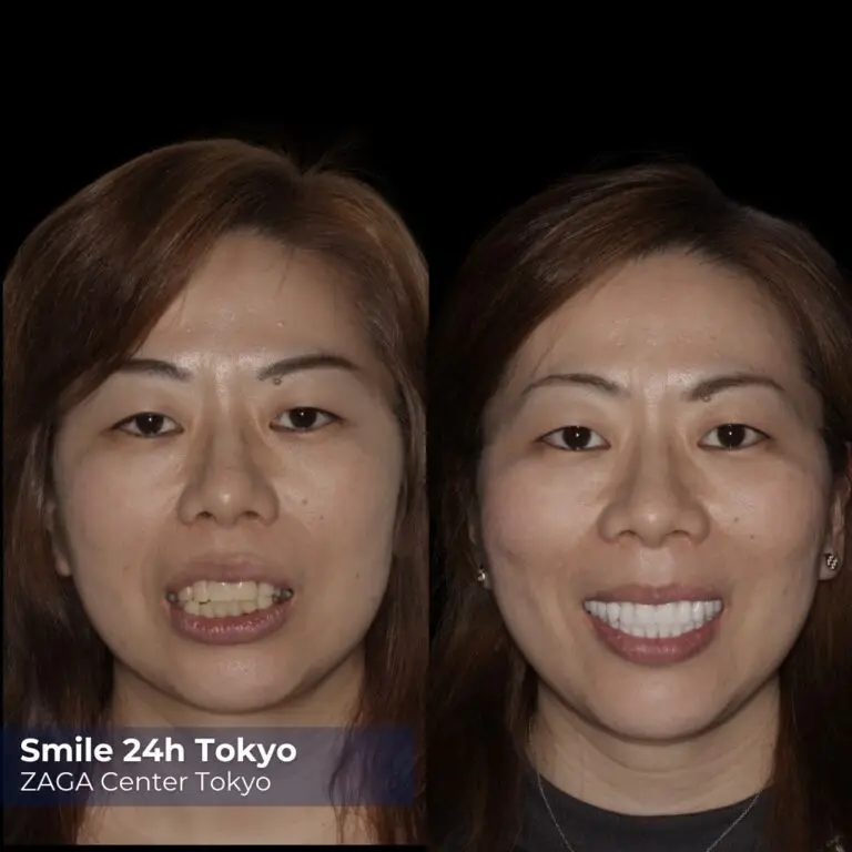 Before After Implants 4