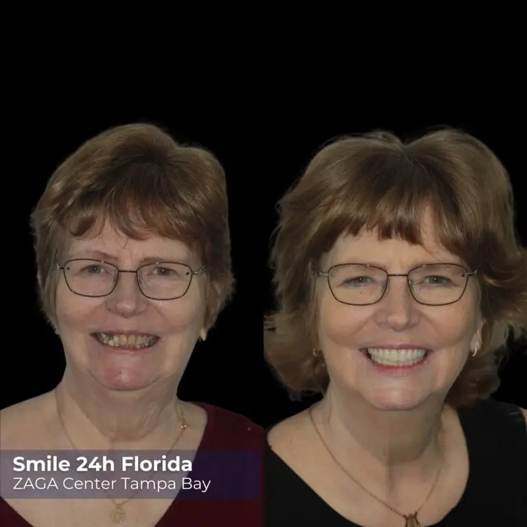 Before After Implants 7