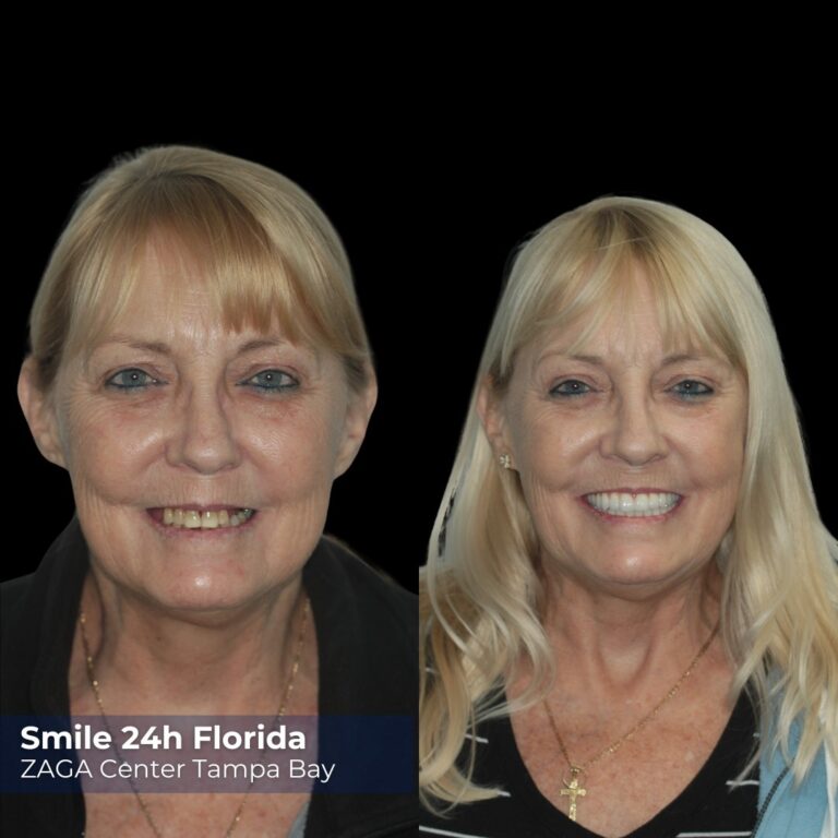 Before After Implants 8