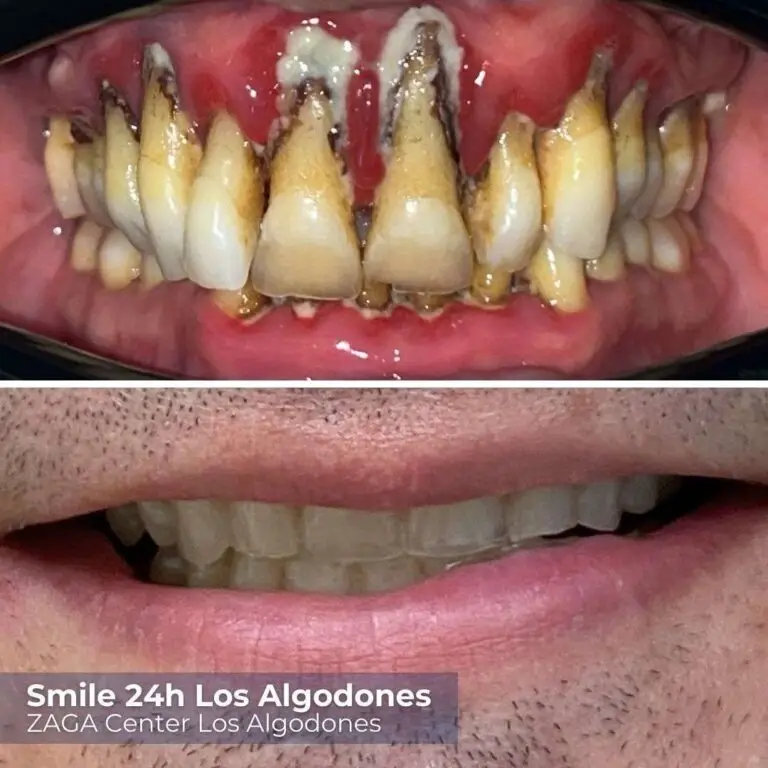 Before After Implants Algodones