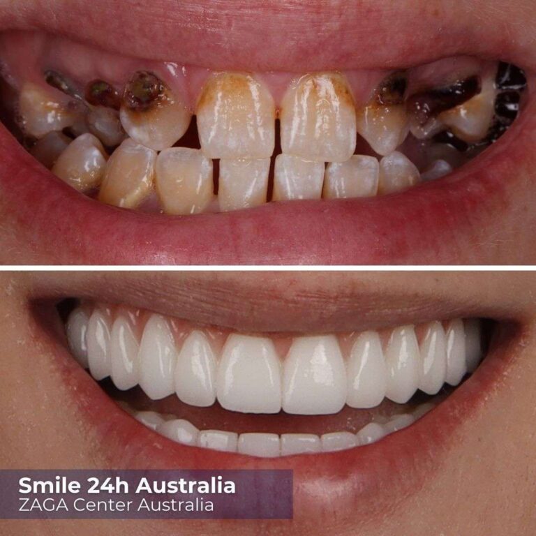 Before After Implants Australia