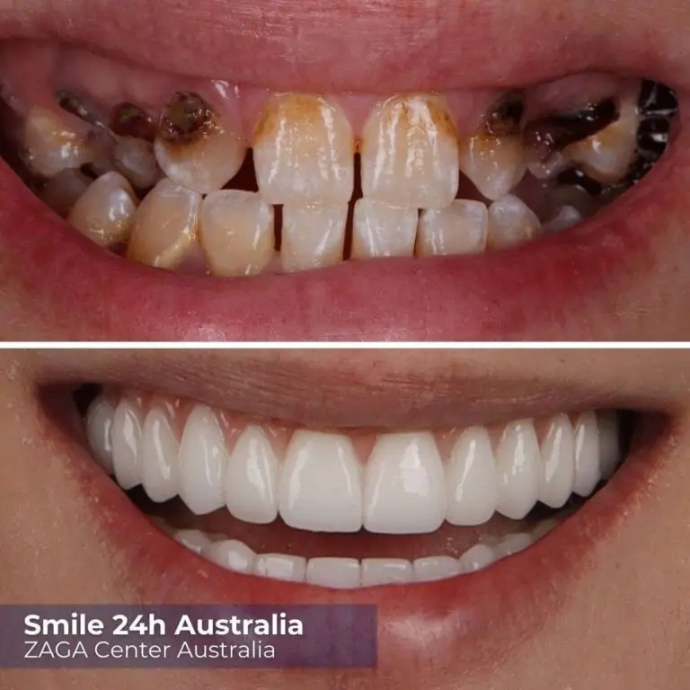Before After Implants Australia