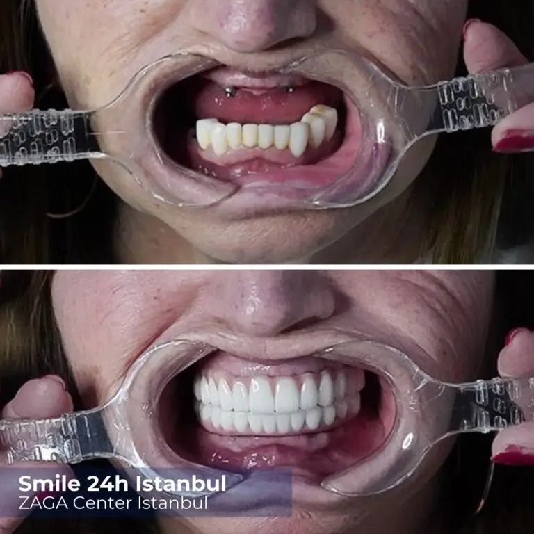 Before After Implants Istanbul