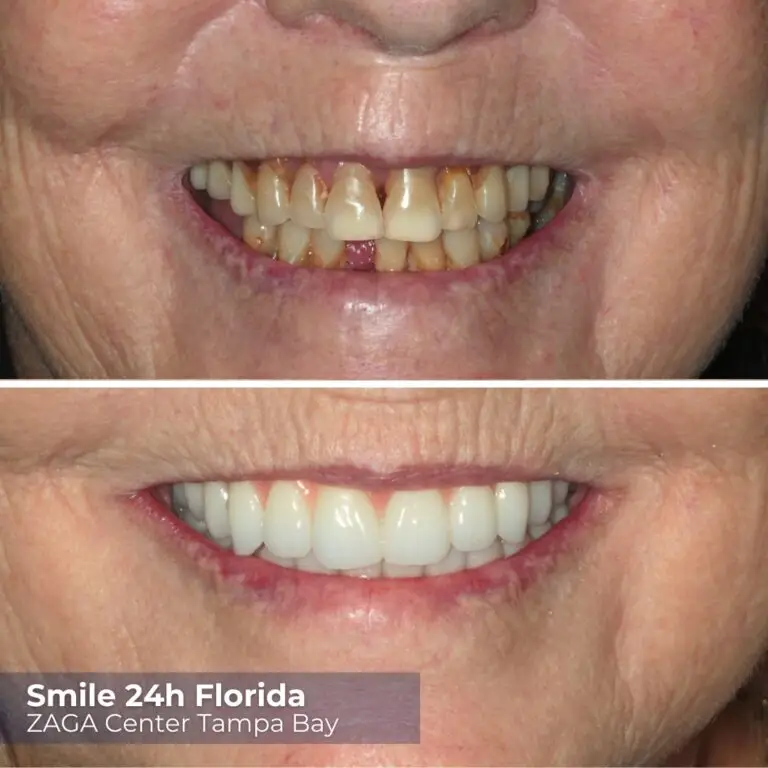 Before After Implants Tallinn 2