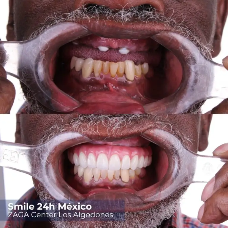 Before After Implants Tallinn
