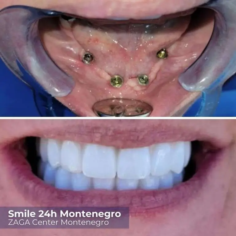 Before After Montenegro