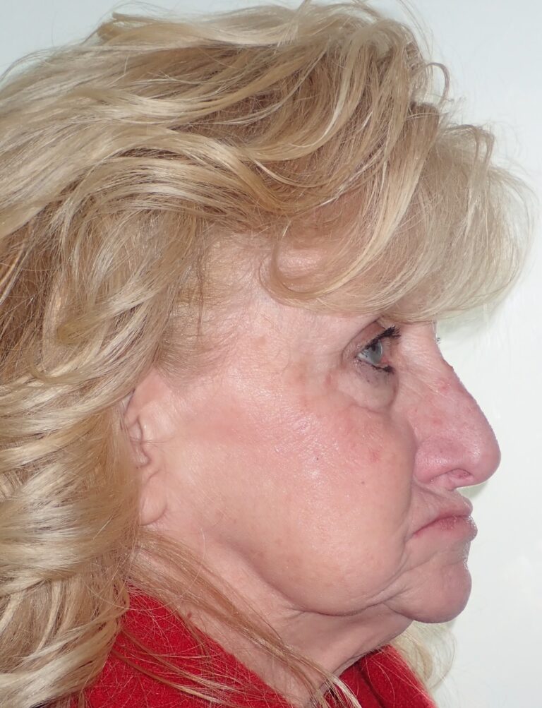 Before and After dental implants - Tammy