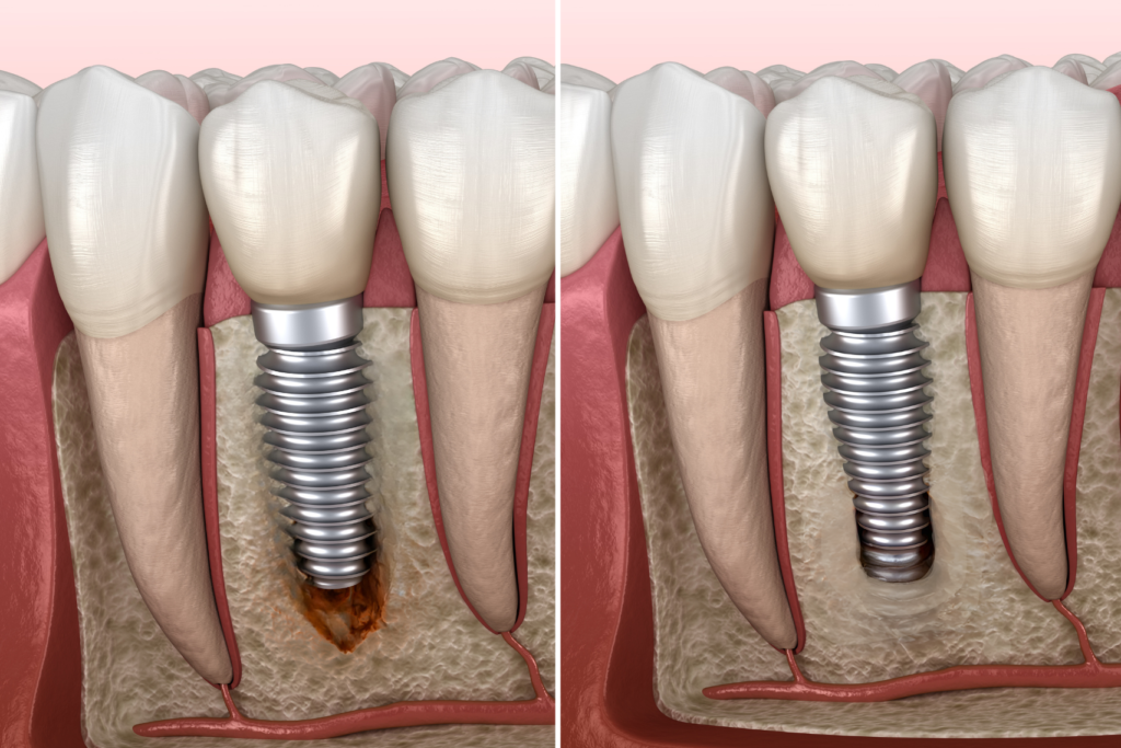 Zintegrowany implant w szczęce. Obraz wyjaśniający