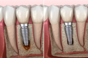 Implant ostéointégré dans la mâchoire. Image explicative