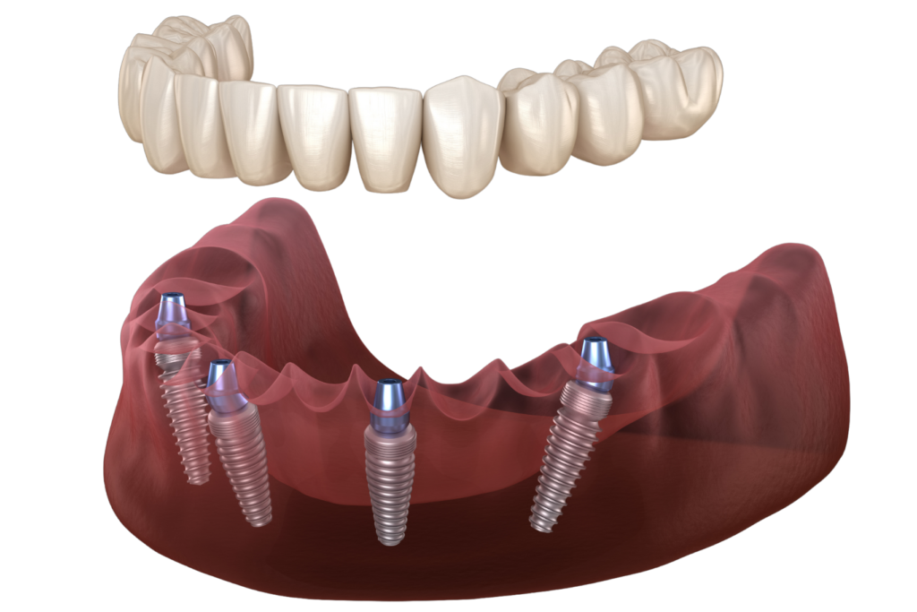 Implanty dentystyczne All-on-4 - proces osseointegracji dla implantów All-on-4