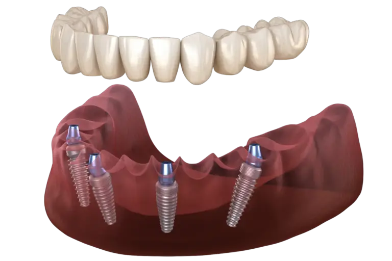 All-on-4 dental implants - osseointegration process for All-on-4 implants