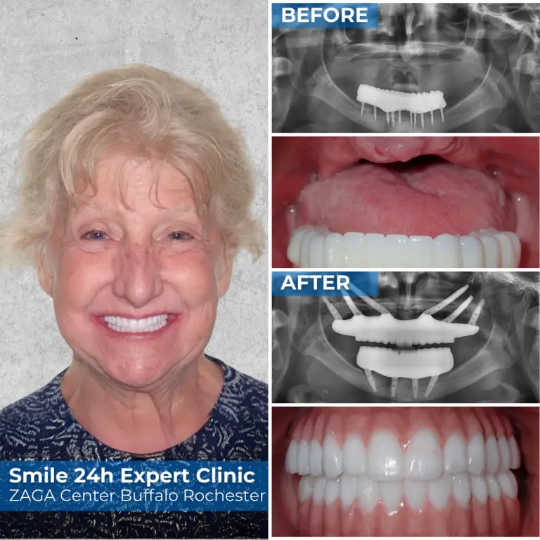 Smile24h Expert Clinic Buffalo Rochester - Patient Story Success Case