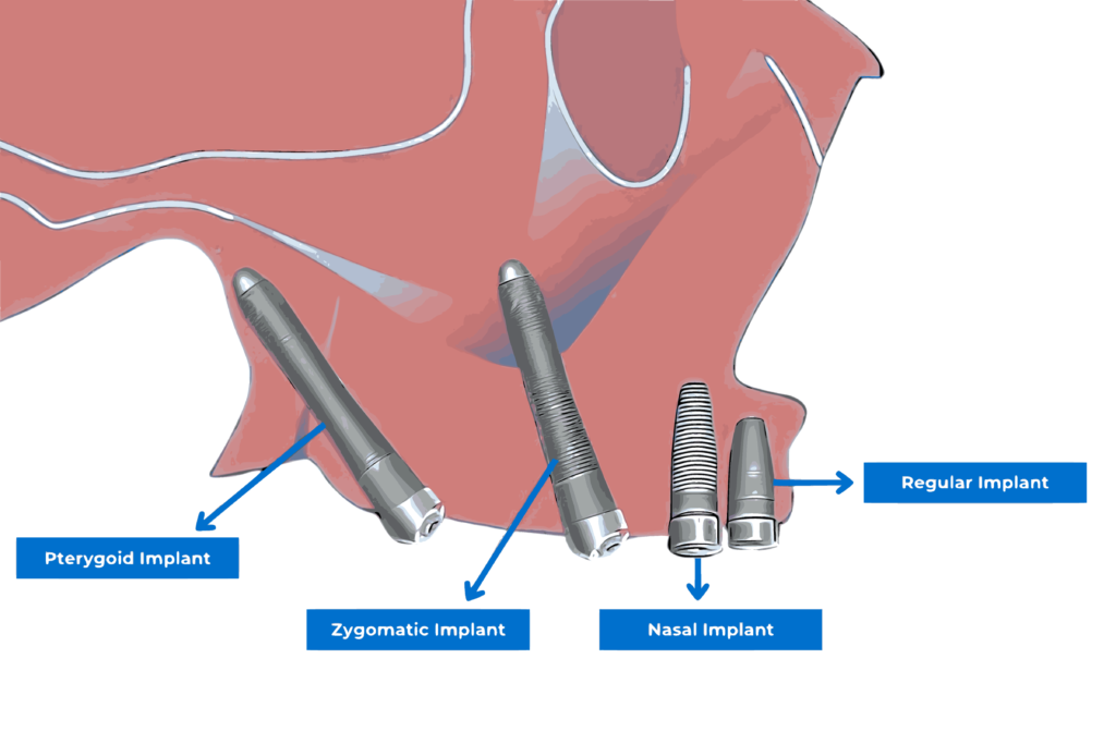 Types of implants illustration - Smile24h