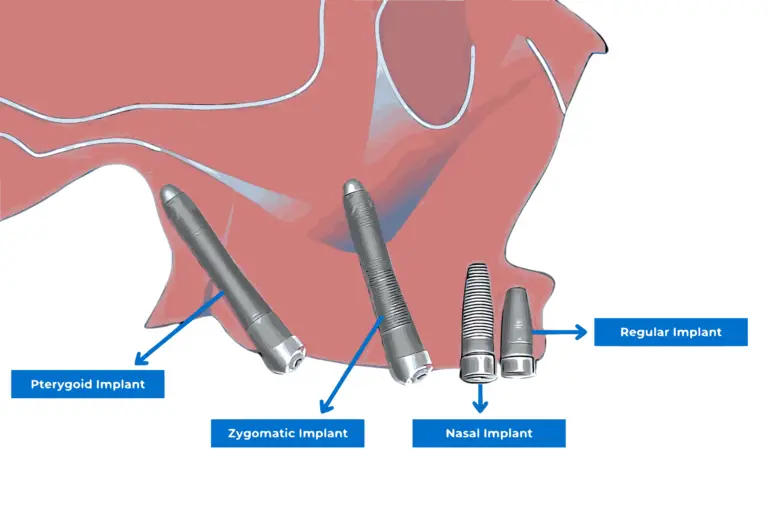 Soorten implantaten illustratie - Smile24h