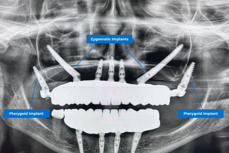 Impianti dentali pterigoidei e zigomatici in un trattamento di riabilitazione a bocca intera