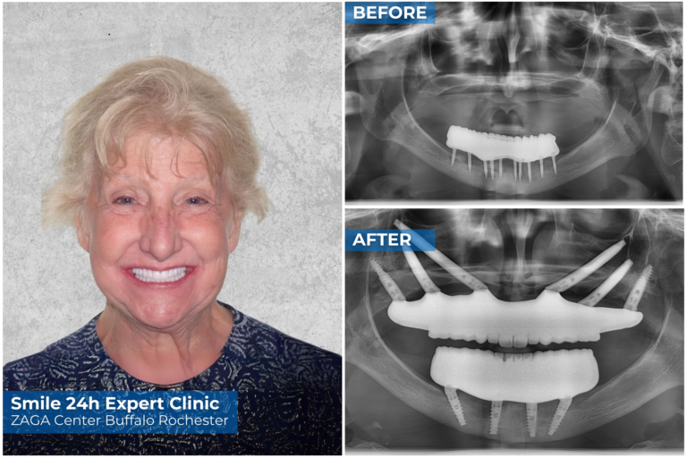 Paziente prima e dopo foto impianti dentali