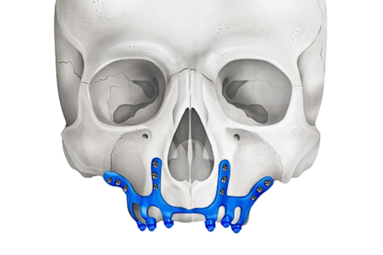 Periostales Implantat - ZAGA Zentrum Valencia
