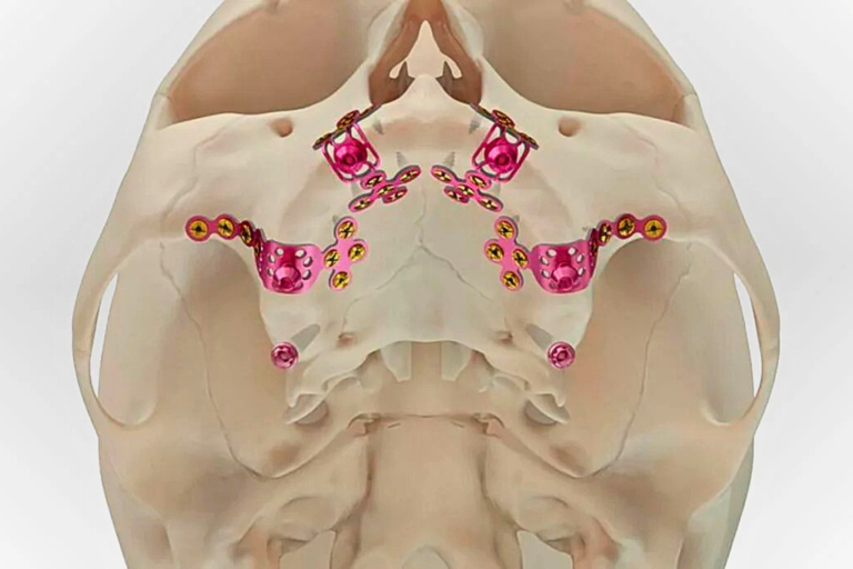 زراعة الأسنان تحت السمعية من مركز زاغا في فالنسيا