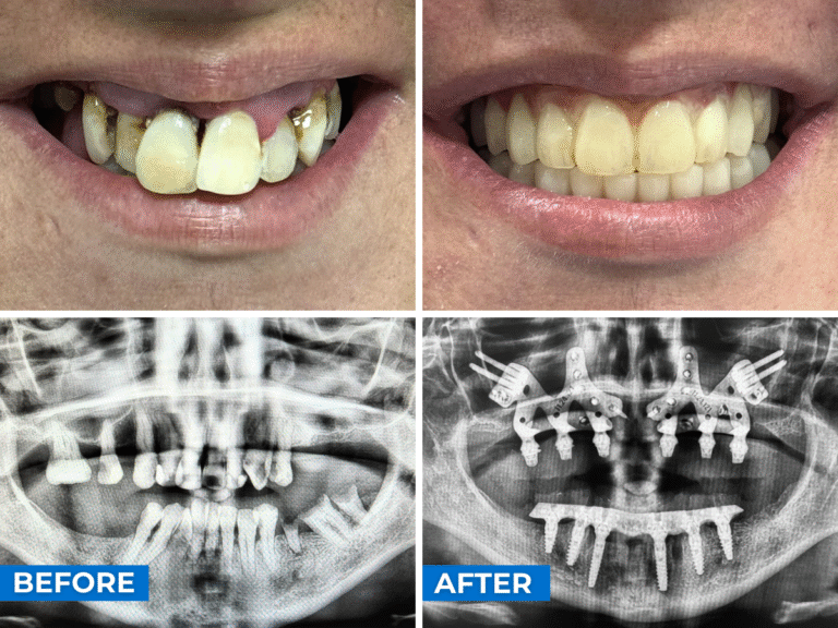 Subperiosteal Dental Implants Case 1