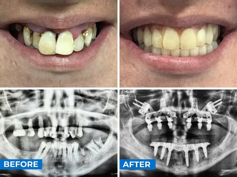Subperiosteal Dental Implants Case 1
