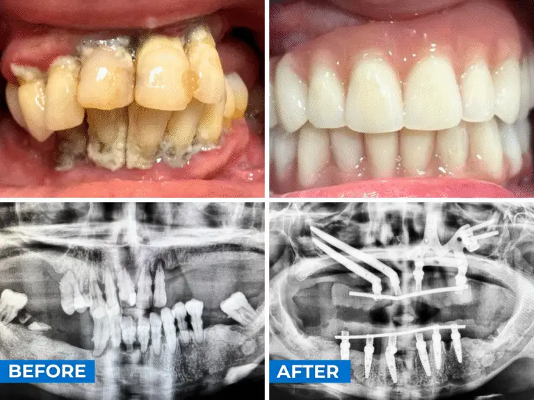 Subperiosteal Dental Implants Case 2
