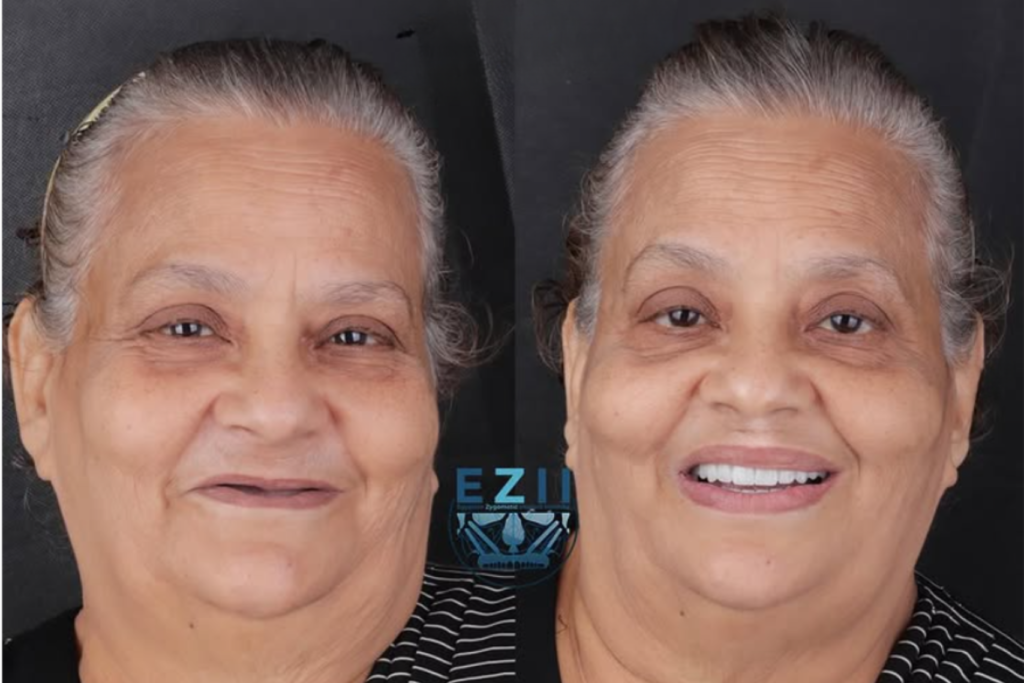 مركز زاجا سنتر القاهرة قصة نجاح مركز زاجا مع زراعة الأسنان الوجنية - قبل وبعد الصورة