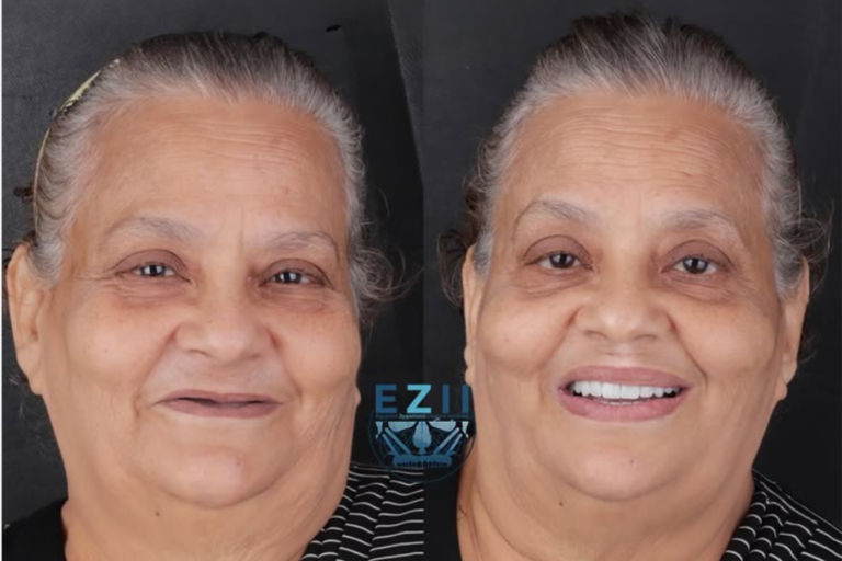 Priča o uspjehu ZAGA Centra u Kairu sa zigomatskim implantatima - fotografija prije i poslije