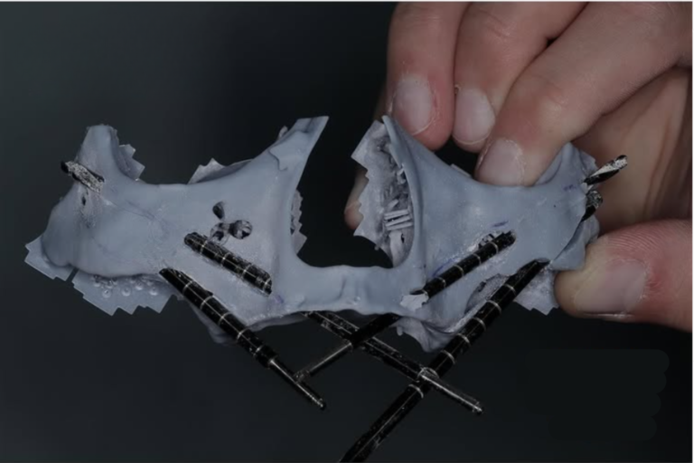 عمليات زراعة الوجنتين - قبل وبعد الصورة - قصة نجاح مركز زاجا سنتر القاهرة