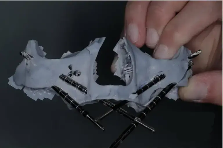 Zygomatic Implants - before and after picture - ZAGA Center Cairo Success Story