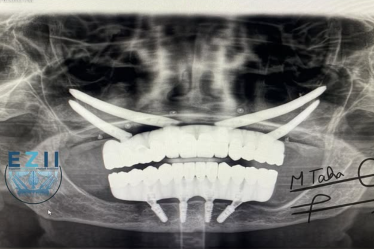 قصة نجاح مريض مركز القاهرة الدولي للمؤتمرات والمعارض CTCB مركز زاجا القاهرة