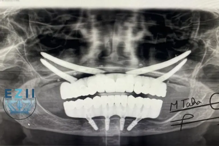 CTCB Patient Success Story ZAGA Center Cairo